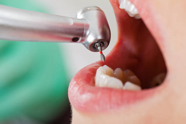 Best Emergency Tooth Extraction in Red Chute, LA